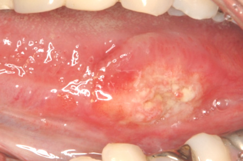 口腔がんや口の病気は早期発見・早期治療