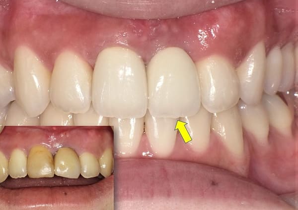 インプラント症例 CASE.01