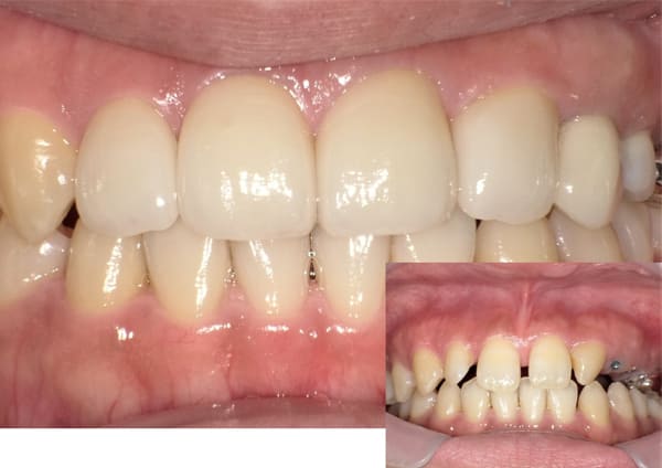 インプラント症例 CASE.02