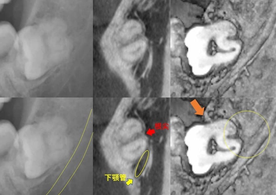 深さが深いのもの（水平）症例2
