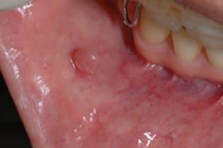 症例１頬粘膜良性腫瘍_治療後