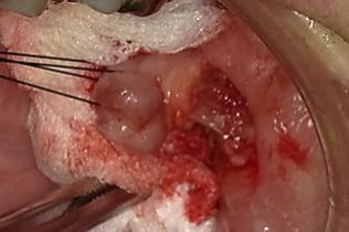 症例5 頬粘膜腫瘍(線維腫)の手術(60歳代 男性)_手術2