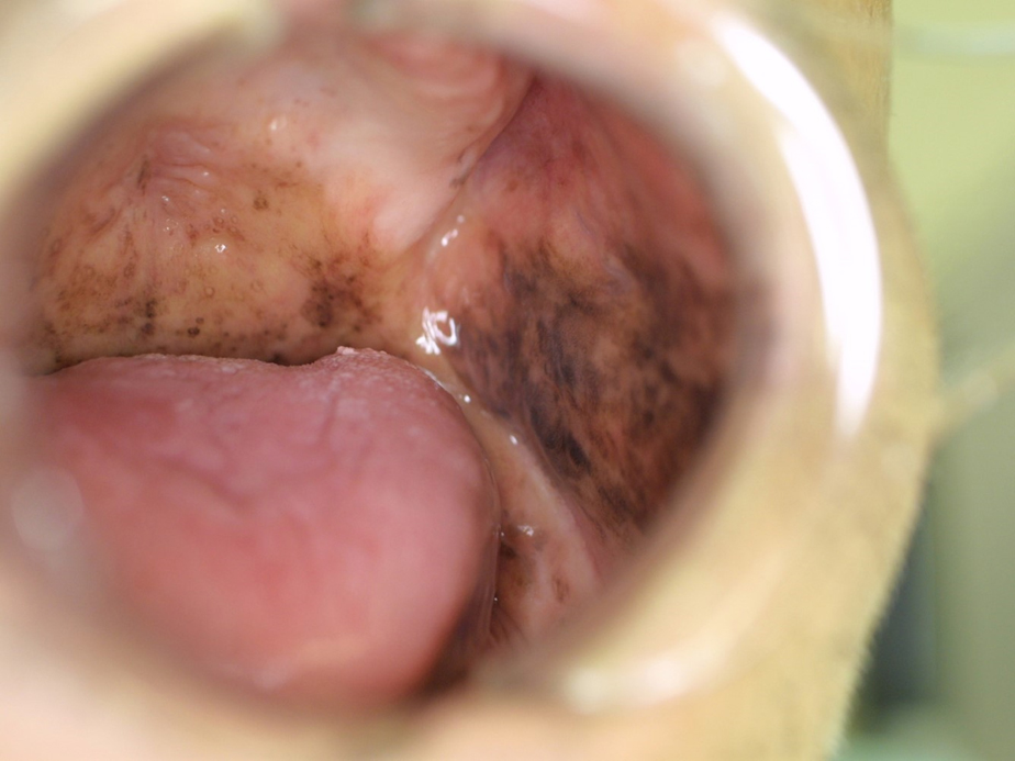 内因性び漫性メラニン色素沈着・生理的色素沈着