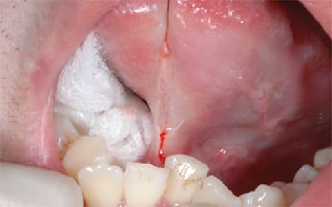 舌小帯強直(短縮)症の手術症例ケース2