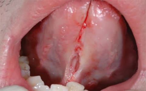 舌小帯強直(短縮)症の手術症例ケース3