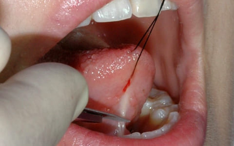舌を糸で牽引して舌小帯にメスを入れて切開する