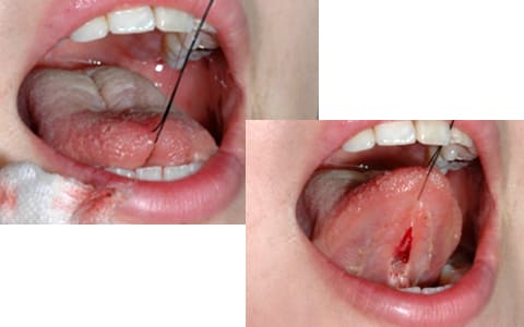 縫合する前に、舌の伸展を舌にかけた糸を牽引して確認する