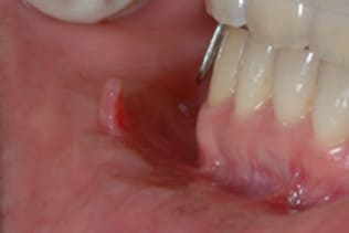 症例１頬粘膜良性腫瘍_治療前