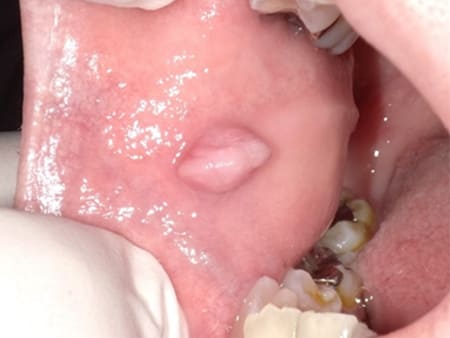 症例２ 頬粘膜線維腫（40歳代 女性）