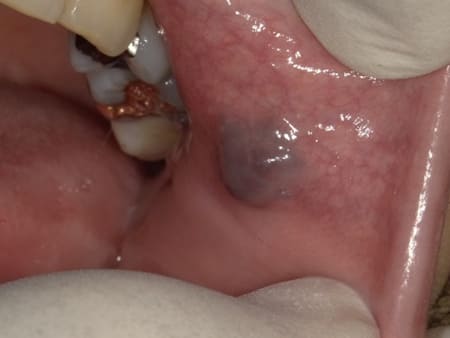 症例３ 左側頬粘膜の血管腫（50歳代 女性）