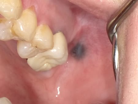 症例４ Navusメラニン色素沈着（20歳代 女性）