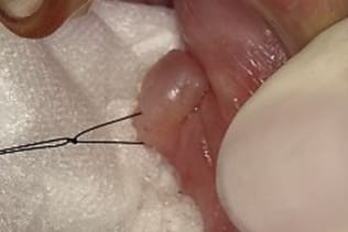 症例５ 頬粘膜腫瘍（線維腫）の手術（60歳代 男性）_手術1