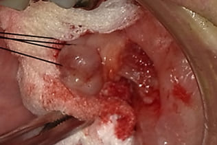 症例５ 頬粘膜腫瘍（線維腫）の手術（60歳代 男性）_手術2