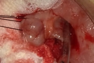 症例５ 頬粘膜腫瘍（線維腫）の手術（60歳代 男性）_手術3