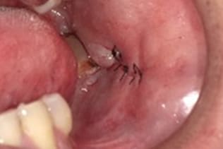 症例５ 頬粘膜腫瘍（線維腫）の手術（60歳代 男性）_手術4