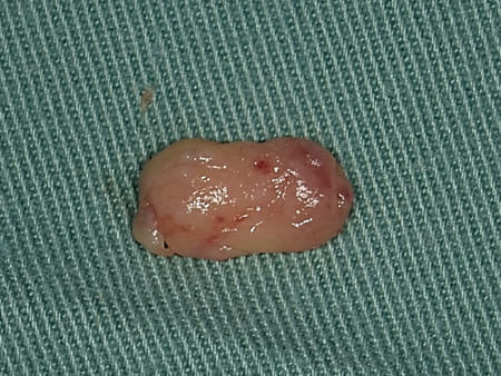 症例５ 頬粘膜腫瘍（線維腫）の手術（60歳代 男性）_手術5