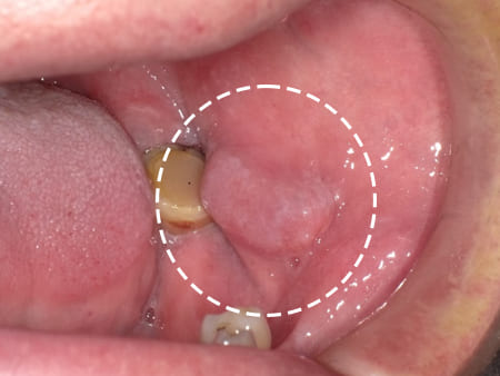 症例５ 頬粘膜腫瘍（線維腫）の手術（60歳代 男性）