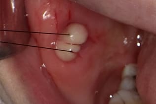 症例６ 頬粘膜腫瘍（線維腫）の手術（40歳代 女性）_手術1