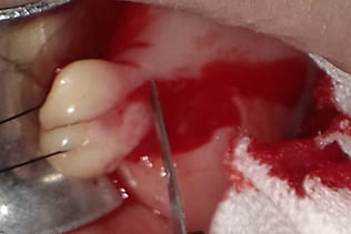 症例６ 頬粘膜腫瘍（線維腫）の手術（40歳代 女性）_手術2