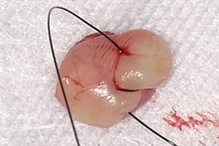 症例６ 頬粘膜腫瘍（線維腫）の手術（40歳代 女性）_手術3