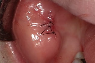 症例６ 頬粘膜腫瘍（線維腫）の手術（40歳代 女性）_手術4