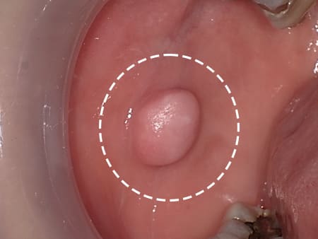 症例6 頬粘膜腫瘍(線維腫)の手術(40歳代 女性)