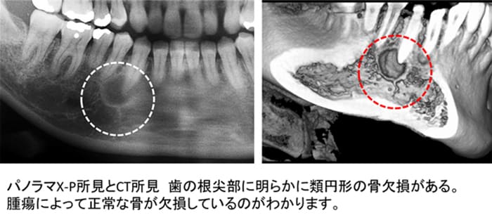 骨形成繊維種摘出術症例ケース１