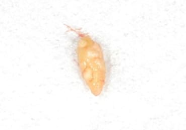 唾石症