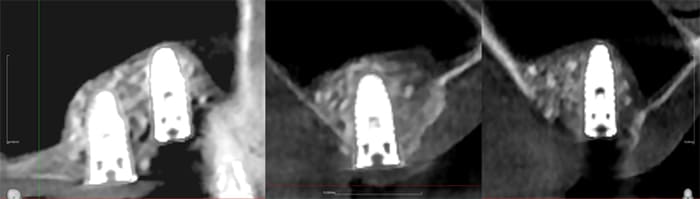サイナスリフトとソケットリフトによる骨増生
