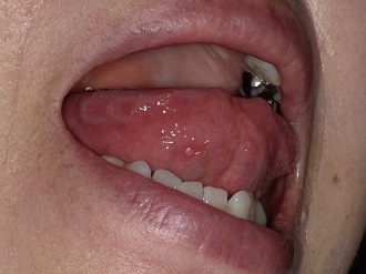 舌の口内炎と舌癌はどう違うのか 役立つ歯科コラム 東京銀座シンタニ歯科口腔外科クリニック