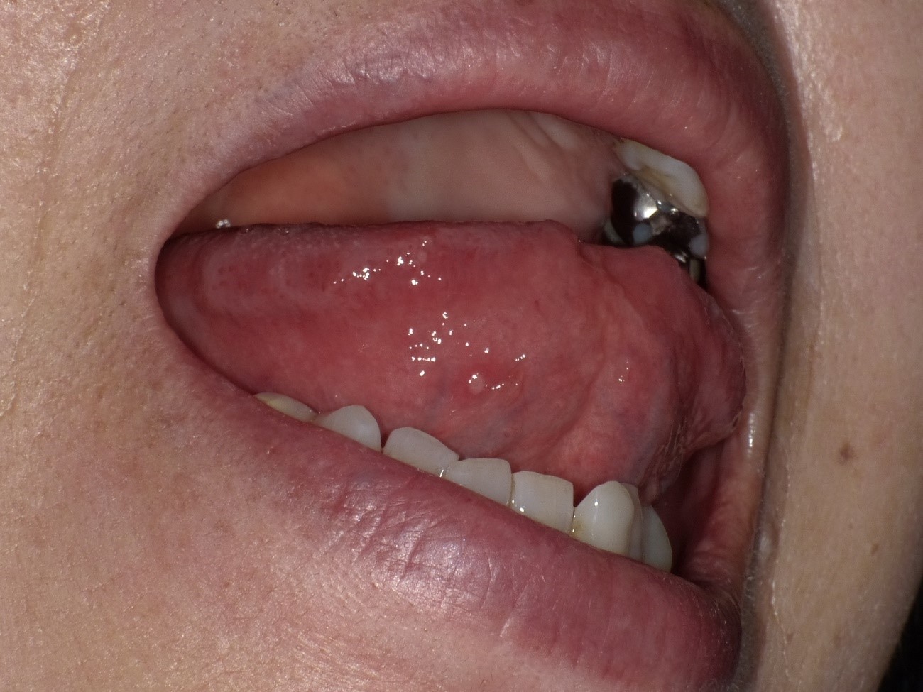 治し 舌 方 やけど 舌を火傷（やけど）したときの応急処置や対処法をわかり易く丁寧に。放っておくと、感染症の危険性も！