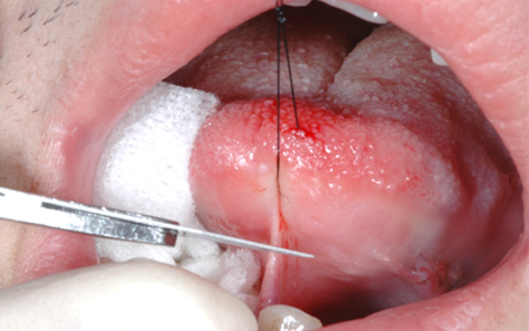 舌小帯短縮症 歯科口腔外科症例解説一覧 東京銀座シンタニ歯科口腔外科クリニック