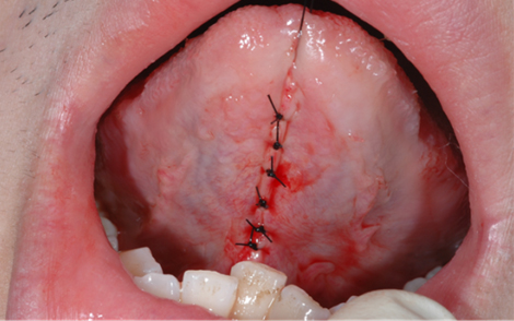 舌小帯短縮症 歯科口腔外科症例解説一覧 東京銀座シンタニ歯科口腔外科クリニック