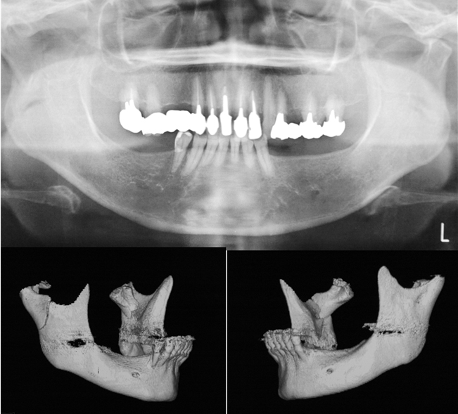顎関節突起骨折とは 歯科口腔外科症例解説一覧 東京銀座シンタニ歯科口腔外科クリニック
