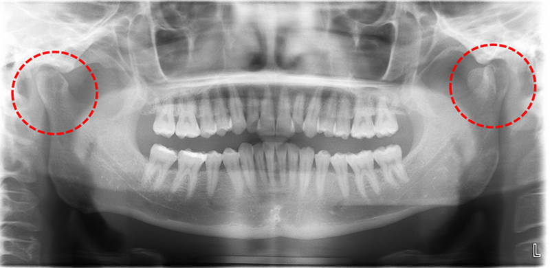 顎関節突起骨折とは 歯科口腔外科症例解説一覧 東京銀座シンタニ歯科口腔外科クリニック