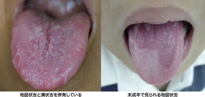 地図状舌とは 歯科口腔外科症例解説一覧 東京銀座シンタニ歯科口腔外科クリニック