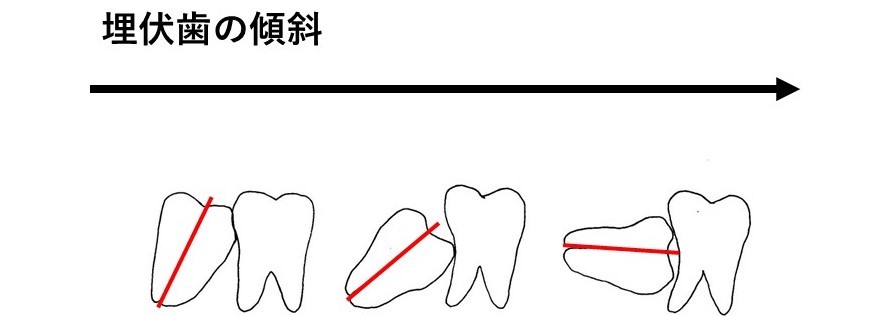 埋伏歯の傾斜の図表
