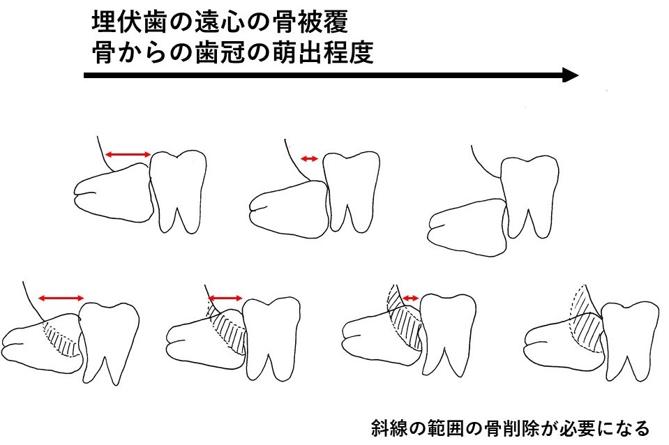 埋伏歯の遠心の骨被覆の図表
