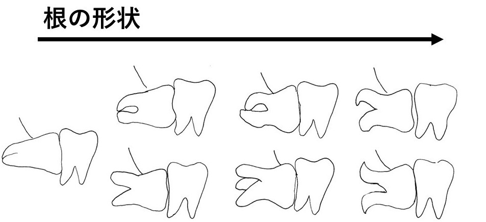 埋伏歯の歯根の形状の図表